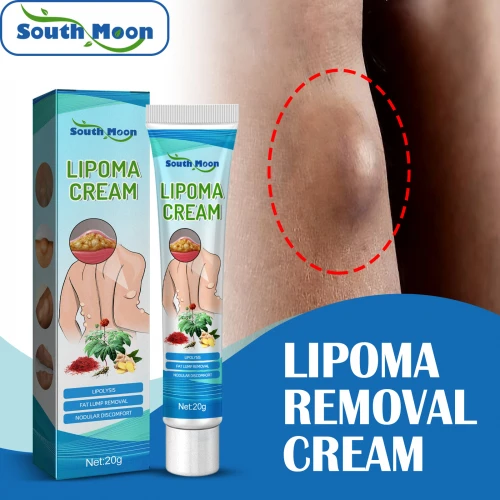Lipoma Removal Cream Treatment Relieve